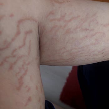 Gülsüm Sözen Beauty Academy Bir Güzellik Merkezinde Hatalı Çatlak Kamuflaj İşlemi