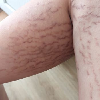 Gülsüm Sözen Beauty Academy Bir Güzellik Merkezinde Hatalı Çatlak Kamuflaj İşlemi