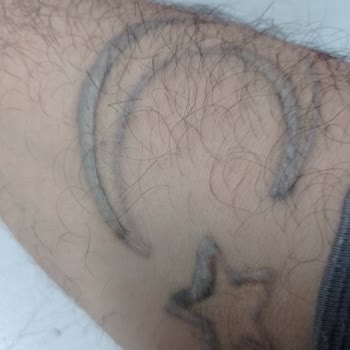 Eva Vip Güzellik Salonu (Zonguldak) Dövme Sildirme Uygulaması!