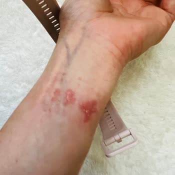 Huawei Fit 2 Akıllı Saat Alerjisi