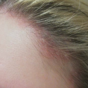 Yves Roche Şampuan Saç Derime Egzama Yaptı