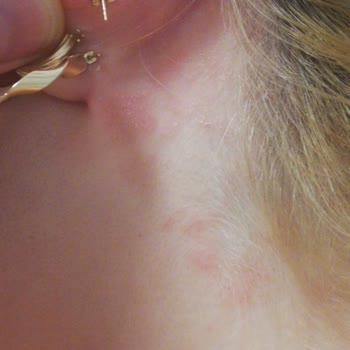 Yves Roche Şampuan Saç Derime Egzama Yaptı