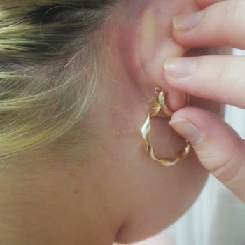 Yves Roche Şampuan Saç Derime Egzama Yaptı