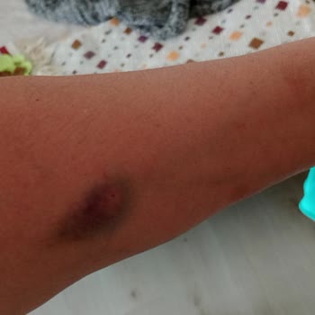 İzmir Bayraklı Şehir Hastanesi Kabusa Dönüşen İğne Deneyimi