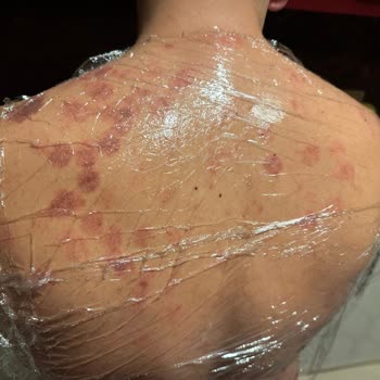 Tilya Estetik Lazer Epilasyonda Sırtımı Yaktılar