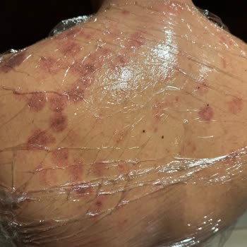 Tilya Estetik Lazer Epilasyonda Sırtımı Yaktılar