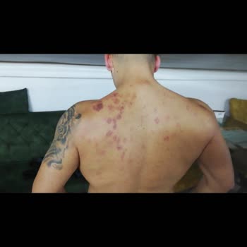 Tilya Estetik Lazer Epilasyonda Sırtımı Yaktılar