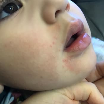 Mustela Stelatopia Krem Pişmanlık