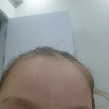 Berko İlaç Alerjik Kabarcıklar Su Toplaması