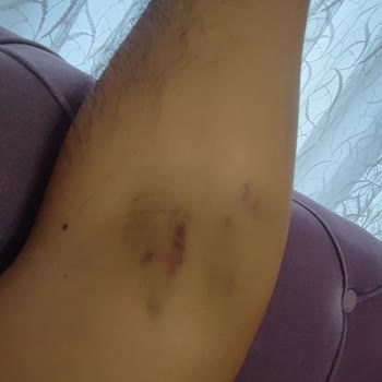 Megapol Hastanesi Damar Yolu Açamayan Tecrübesiz Ve Mosmor Kol Bırakan Hemşire