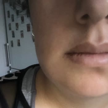 İstanbul Sultangazi Ağız ve Diş Sağlığı Merkezi İltihaplı Diş Çekti