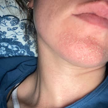 Garnier Yanma Kaşıntı Sivilce