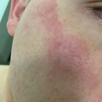 Gillette Yüzü Tahriş Etmesi