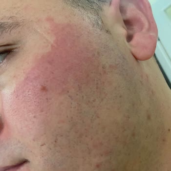 Gillette Yüzü Tahriş Etmesi