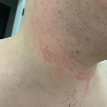 Gillette Yüzü Tahriş Etmesi