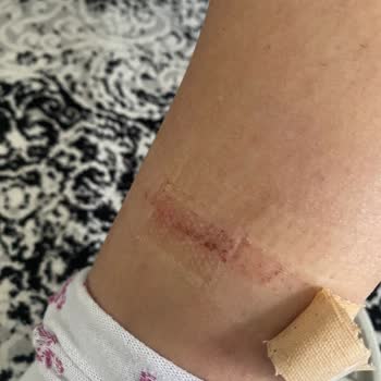 Calvin Klein Bot Yara Yaptı