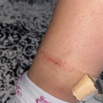 Calvin Klein Bot Yara Yaptı