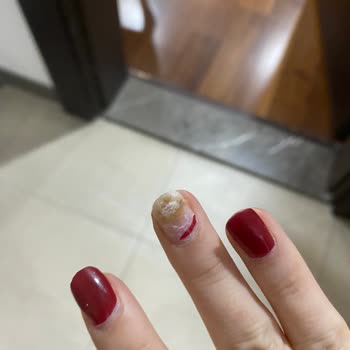 Moi Güzellik ve Bakım Salonu'nda Jel Tırnak Mantar Enfeksiyonu