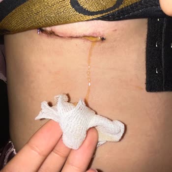 Estecenter Göğüs Büyültme Ameliyat Dikiş Mağduriyetim