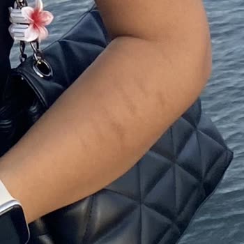 Nurcan Kaplan Beauty Lazer Yaparken Kolumu Yaktılar