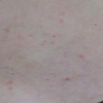 A101 Şampuan Kimyasal Alerji Yaptı