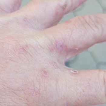 Hobby Şampuan Kimyasal Alerji Yaptı