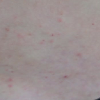 Hobby Şampuan Kimyasal Alerji Yaptı