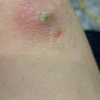 Hobby Şampuan Kimyasal Alerji Yaptı