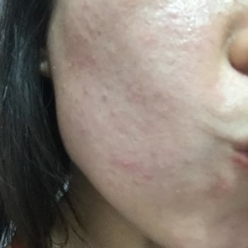 Yüzümde Alerji Yaratan Nivea Ürünü!