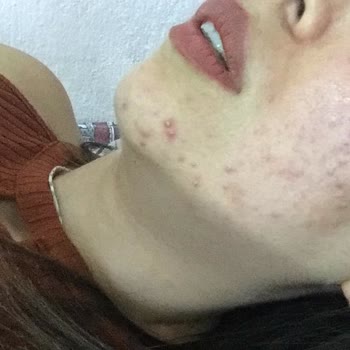 Yüzümde Alerji Yaratan Nivea Ürünü!