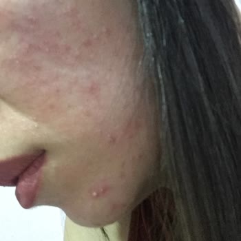 Yüzümde Alerji Yaratan Nivea Ürünü!