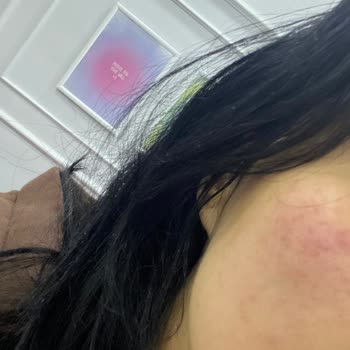 The Purest Solutions Kırmızı Peelingi Yüzümü Yaktı Ve Sivilce Yuvasına Döndürdü