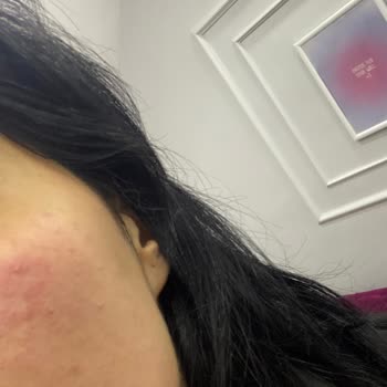 The Purest Solutions Kırmızı Peelingi Yüzümü Yaktı Ve Sivilce Yuvasına Döndürdü