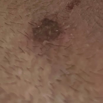 Orva İlaç Sanayi Verrutol Kullanımı Sonrası Cilt Lekesi ve Ağrı