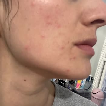 The Purest Solutions Kullandığım Ürünler Cilt Problemlerine Sebep Oldu