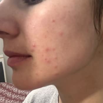 The Purest Solutions Kullandığım Ürünler Cilt Problemlerine Sebep Oldu