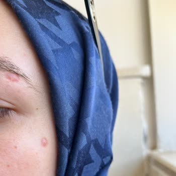 İdea Klinik Ben Aldırma Sonucu Kırmızı İz