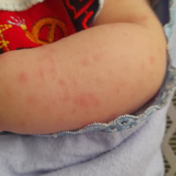 Orzax İlaç Bebeğimde Çıkan Sivilceler
