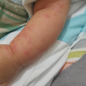 Orzax İlaç Bebeğimde Çıkan Sivilceler