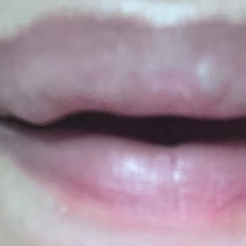 You Beauty Gebze Ne Kadar Kötü Dudak Dolgusu Yapılır