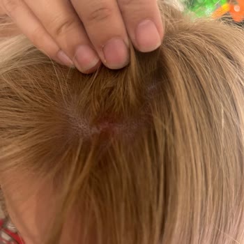 Palette Saç Derisi Yandı