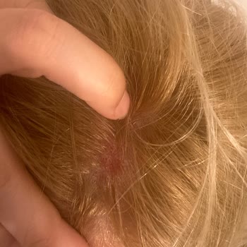 Palette Saç Derisi Yandı