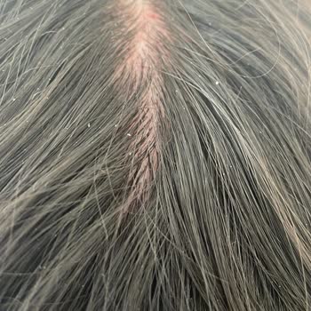 Krijen Doğal Bakım Ürünleri Krijen Şampuan Kepek Yara Kaşıntı Yaptı