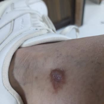 Climed Tedavi Merkezi Climed Ümraniye Bacaklarımı Yaktı