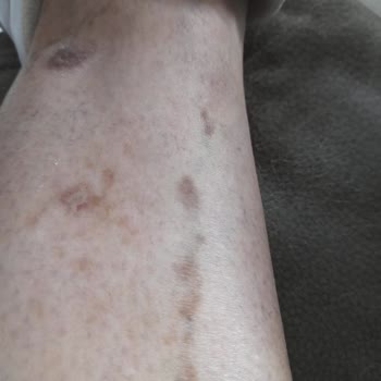 Climed Tedavi Merkezi Climed Ümraniye Bacaklarımı Yaktı