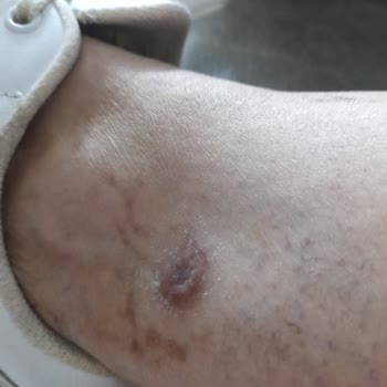 Climed Tedavi Merkezi Climed Ümraniye Bacaklarımı Yaktı