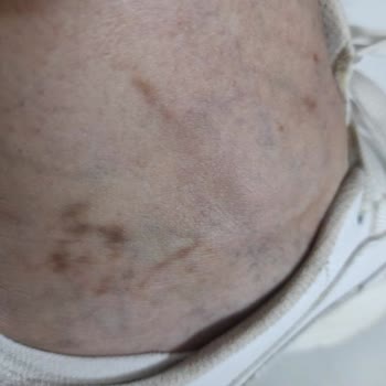 Climed Tedavi Merkezi Climed Ümraniye Bacaklarımı Yaktı