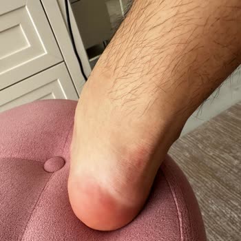 Derimod Ayakkabıları Ayağımı Yara Yaptı