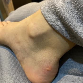 Bershka Ayakkabı Ayağımı Yara Yaptı