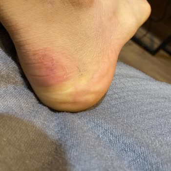 Bershka Ayakkabı Ayağımı Yara Yaptı